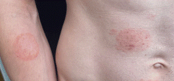 Image of TMVII lesions on the right arm and torso, on white skin.
