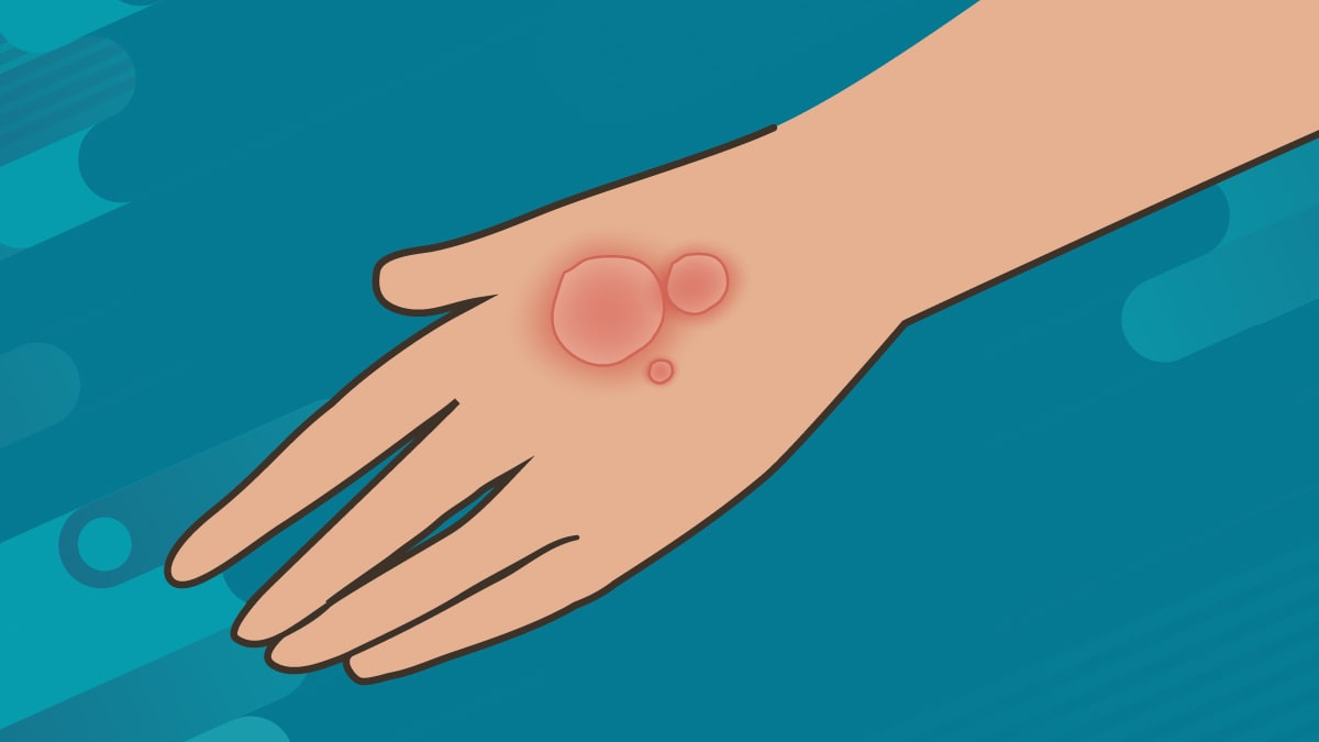 illustration of red ring-shaped rash on a hand.
