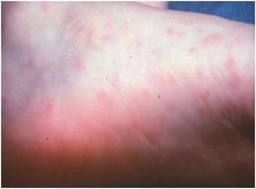 Early Stage of Rocky Mountain Spotted Fever