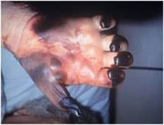 Digital necrosis in hand with untreated Rocky Mountain Spotted Fever