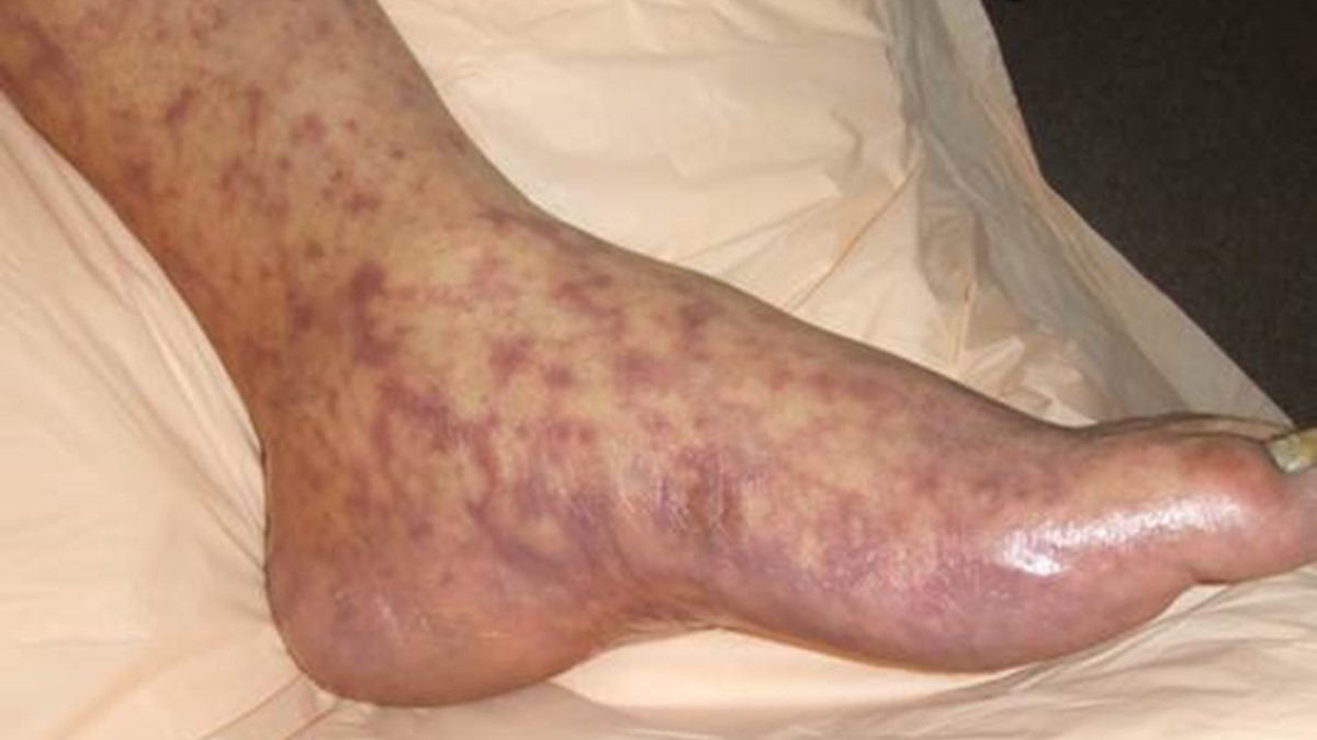 Rocky Mountain Spotted Fever rash on foot.