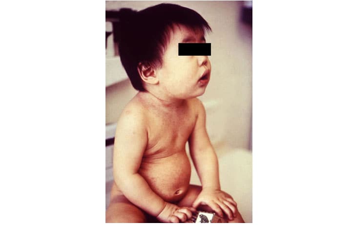 This is baby has a mild rash with pink and red spots caused by rubella
