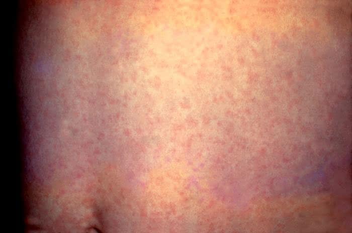 This person has a generalized rash on the stomach caused by rubella.