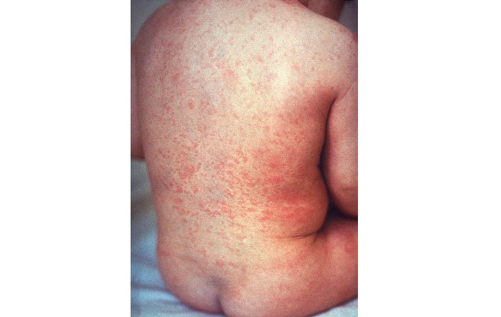 un niño enfermo por rubéola sentado en una cama mostrando su espalda