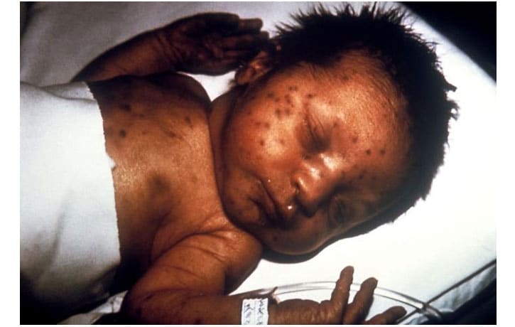 This baby presented with 'blueberry muffin' skin lesions due to congenital rubella syndrome