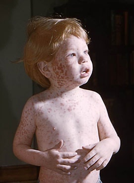 Boy with body rash