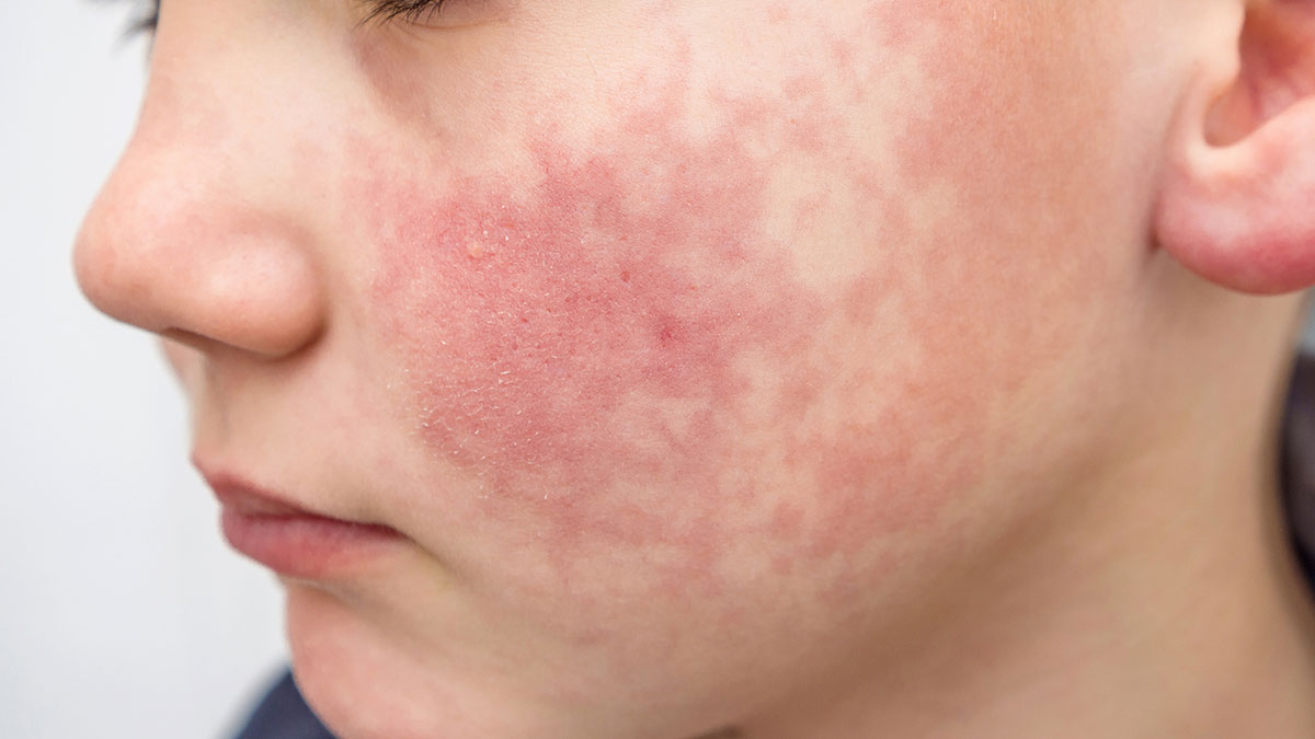 Rubella Symptoms And Complications Rubella CDC rubella-symptoms-and-complications-rubella-cdc