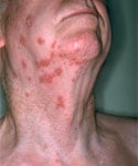 woman with shingles on neck