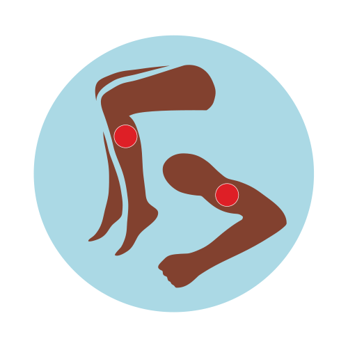 Illustration showing blood clots on an arm and a leg.