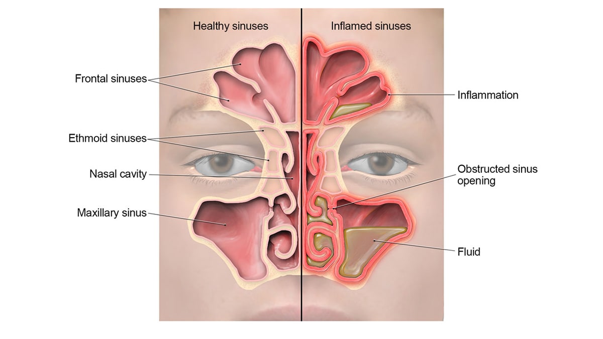 Anatomy of the sinuses, showing where inflammation occurs and fluid builds up during a sinus infection.