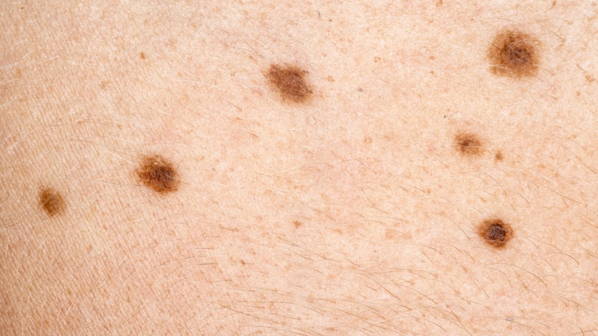 moles on the skin