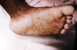 image of smallpox on foot