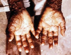 image of smallpox on hands