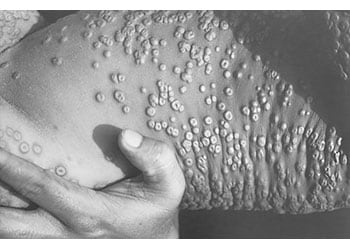 Smallpox lesions on the torso of a patient in Bangladesh in 1973. Source: CDC/James Hicks. 