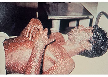 Male smallpox patient with lesions on upper body, arms, face, and neck. Source: CDC/Barbara Rice.