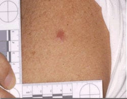 Arm of patient who was unsuccessfully vaccinated for smallpox. Vaccination site has an area of erythema but no central lesion. Source: Ramzy Azar, LTJG, MSC, United States Navy: National Naval Medical Center, Bethesda, MD.