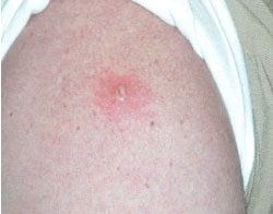 Arm of vaccinated patient showing a central lesion, indicating a successful “take.” Source: Ramzy Azar, LTJG, MSC, United States Navy: National Naval Medical Center, Bethesda, MD.