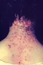 This photograph displays the nape of a neck of a woman with eczema vaccinatum. This patient had a history of eczema. Source:  CDC.
