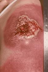 The initial vaccination site of a patient with progressive vaccinia. Source:  CDC/Dr. Clement R. Boughton.