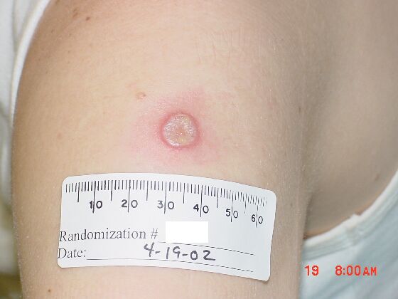 Example of vaccine “take” on day 10 after vaccination in a first-time vaccinee.