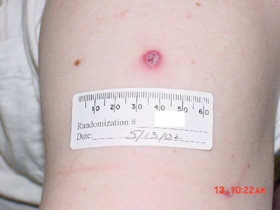 Example of a %26ldquo;take%26rdquo; on day 8 after vaccination in a revaccinee.