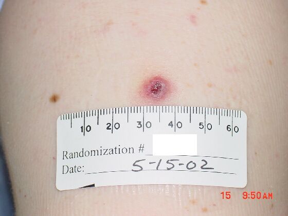 Example of a %26ldquo;take%26rdquo; on day 10 after vaccination in a revaccinee.