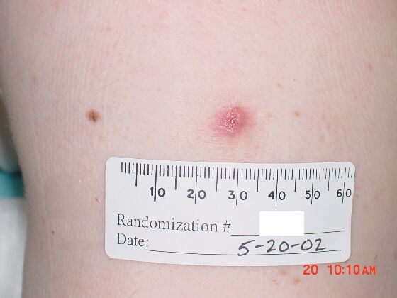 Example of vaccine %26ldquo;take%26rdquo; on day 15 after vaccination in a revaccinee.