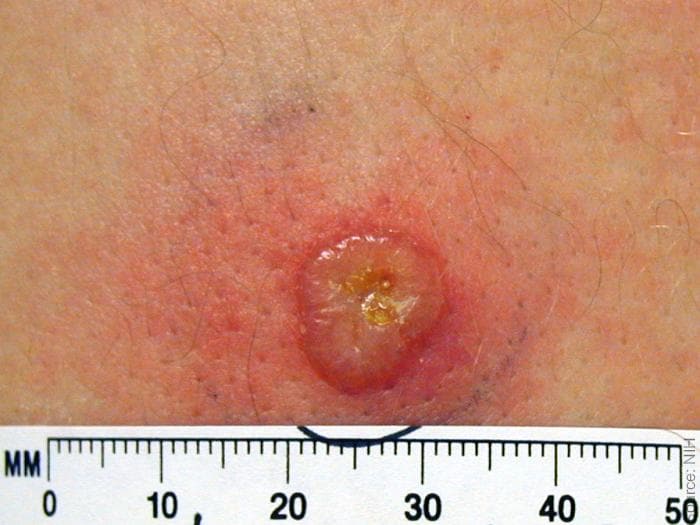 Normal primary, 8 days post vaccination. Large vesicle on erythematous base. Source: NIH, digital enhancement %26copy; Logical Images.