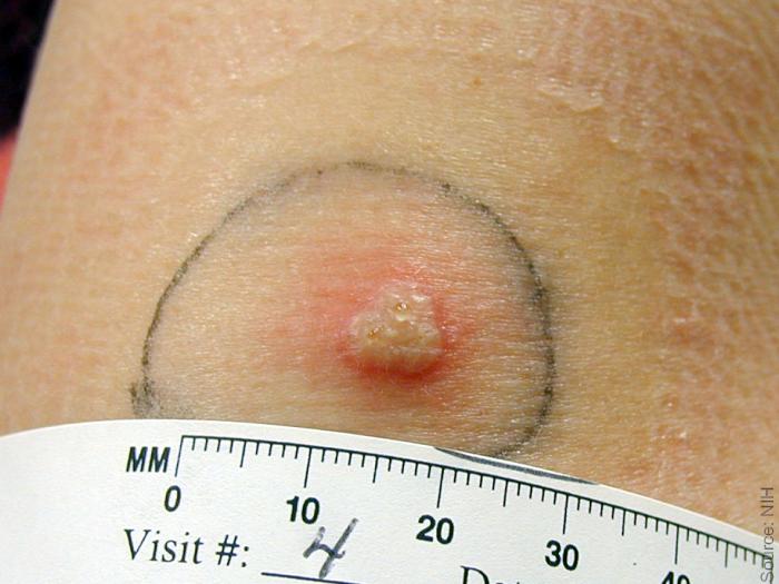 Normal primary, 8 days post vaccination. Minimal surrounding erythema at 8 days. Source: NIH, digital enhancement © Logical Images.