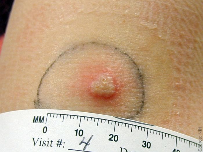 Normal primary, 8 days post vaccination. Minimal surrounding erythema at 8 days. Source: NIH, digital enhancement %26copy; Logical Images.