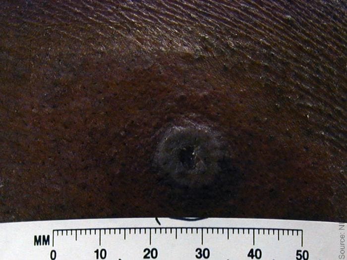 Normal primary, 8 days post vaccination. Grayish pustule, with difficult to detect surrounding erythema in dark skin. Source: NIH, digital enhancement © Logical Images.
