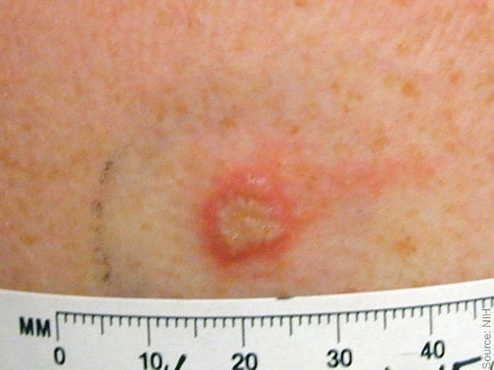 Normal primary, 8 days post vaccination. Small vesicle with minimal erythema at 8 days post vaccination. Source: NIH, digital enhancement %26copy; Logical Images.