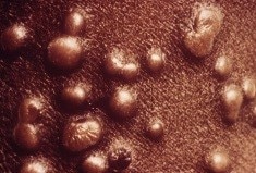 image of smallpox: Pustular Rash and Scabs
