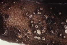 image of smallpox: Scabs Fall Off 