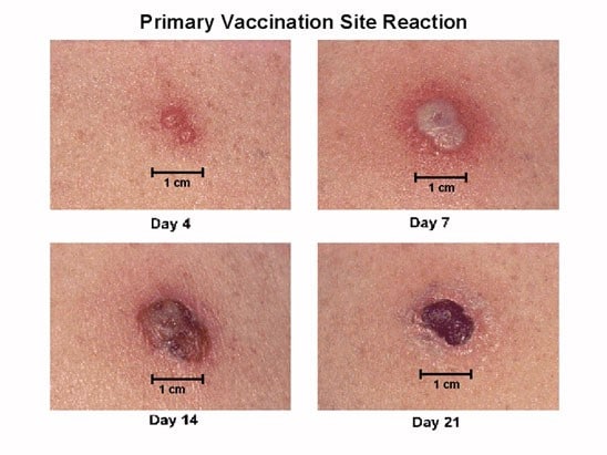 Priomary Vaccincation Site Reation image. Vaccination site reaction at day 4, 7, 14, and 21 intervals