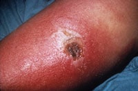 Another view of progressive vaccinia lesion in patient with chronic granulocytic leukemia.