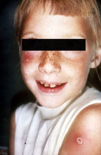 Child with auto-inoculation of cheek and arm with vaccinia virus.