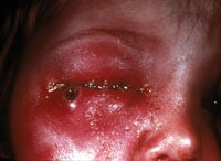 Accidental auto-inoculation of eyelid with vaccinia virus with concurrent cellulitis.