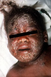 Eczema vaccinatum on the face of a child.