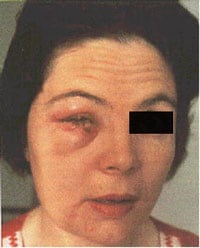 Woman with accidental auto-inoculation of lower eyelid with vaccinia virus.