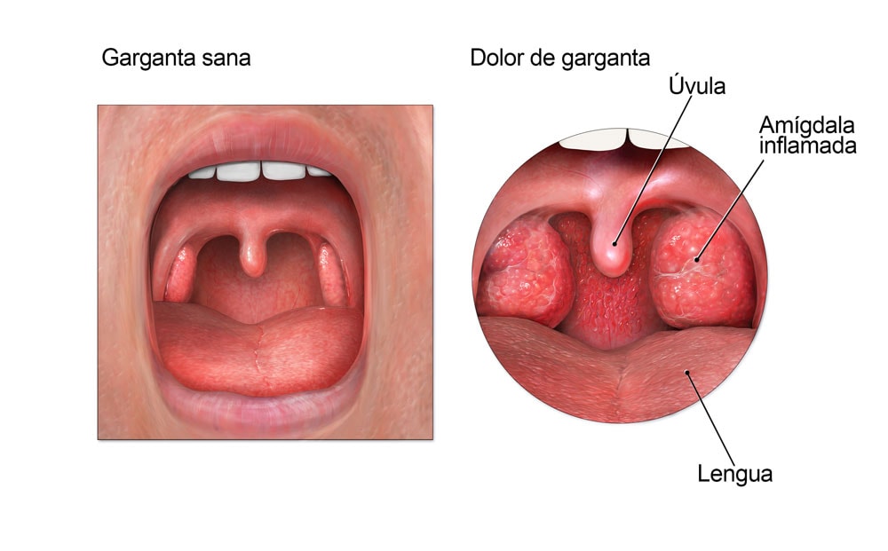 Diagrama de la anatomía de la boca que muestra las amígdalas inflamadas durante un dolor de garganta.