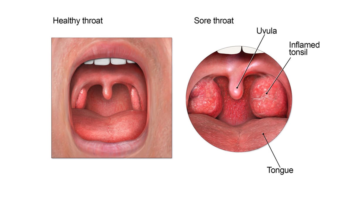 Anatomy of the mouth, showing inflamed tonsils in a sore throat.