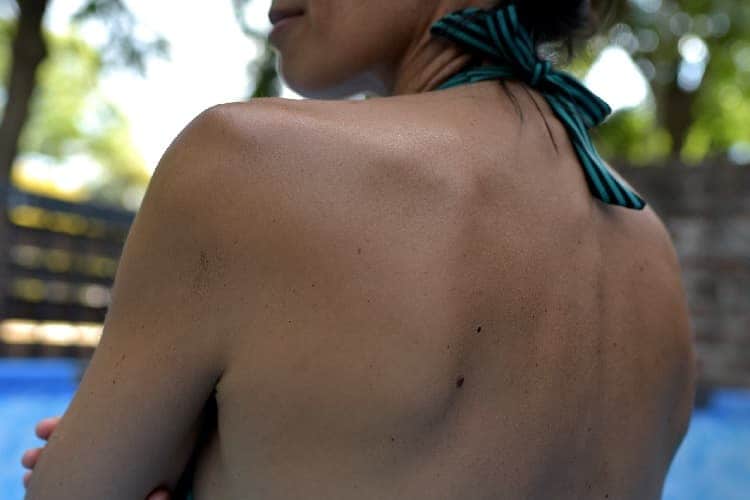Foto de una mujer con lunares en la espalda