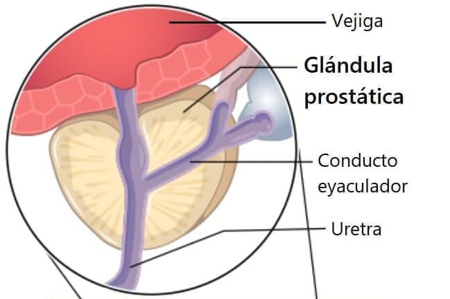 Ilustración de la próstata, la vejiga, la gládula prostática, el conducto eyaculador, y la uretra.