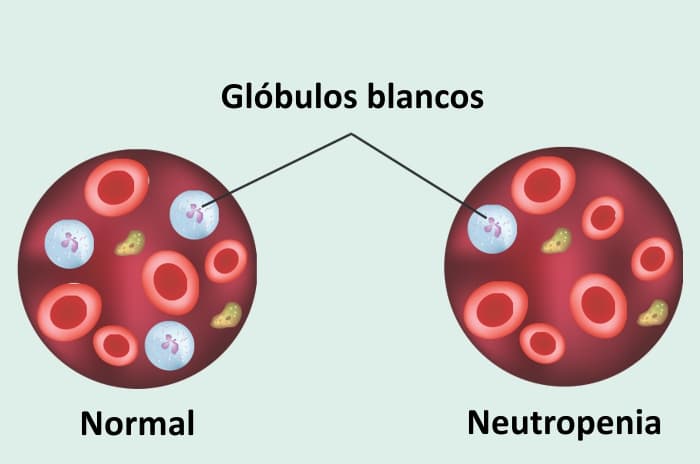 Ilustración de glóbulos normales y glóbulos con neutropenia