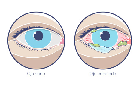 Un ojo sano y un otro infectado