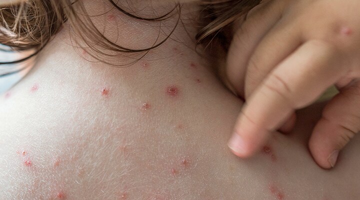 La espalda de un niño con varicela.