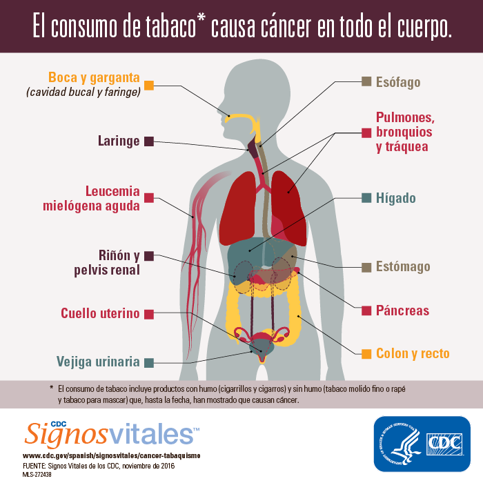 Infografía: El consumo de tabaco* causa cáncer en todo el cuerpo.