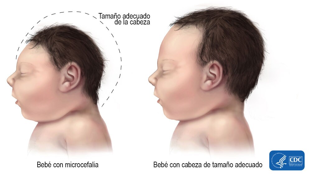 Comparación del tamaño típico de la cabeza de un bebé y de la cabeza de un bebé con microcefalia. 