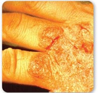 Vista superior del dorso de una mano mostrando irritación grave y grietas en la piel